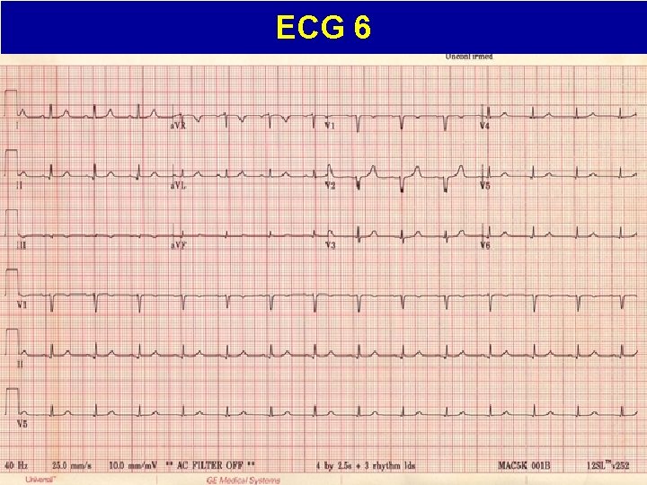 ECG 6 