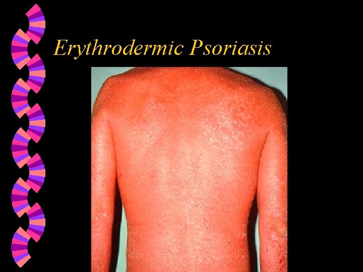 erythrodermic psoriasis definition