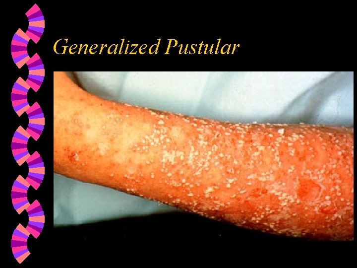 Generalized Pustular 