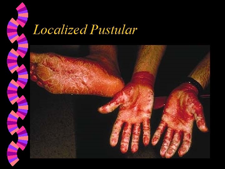 Localized Pustular 