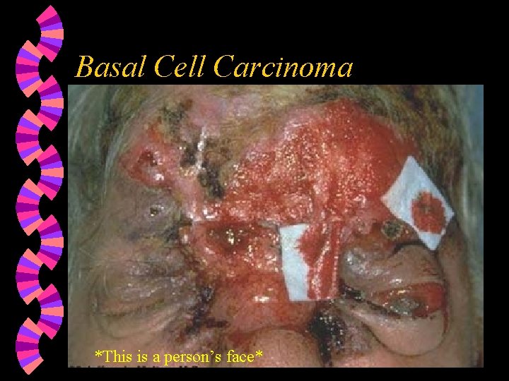Basal Cell Carcinoma *This is a person’s face* 