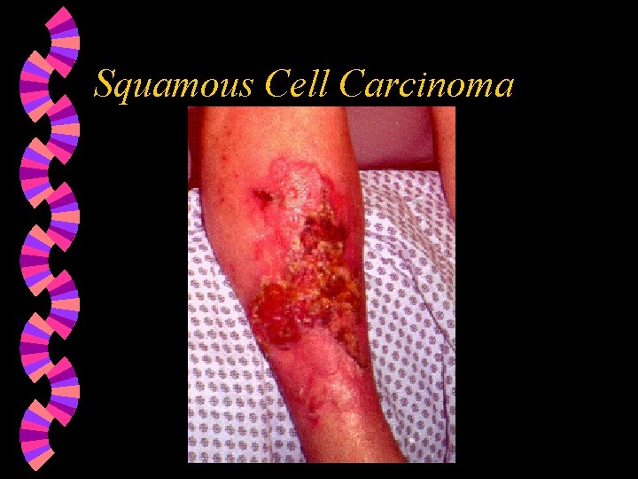 Squamous Cell Carcinoma 