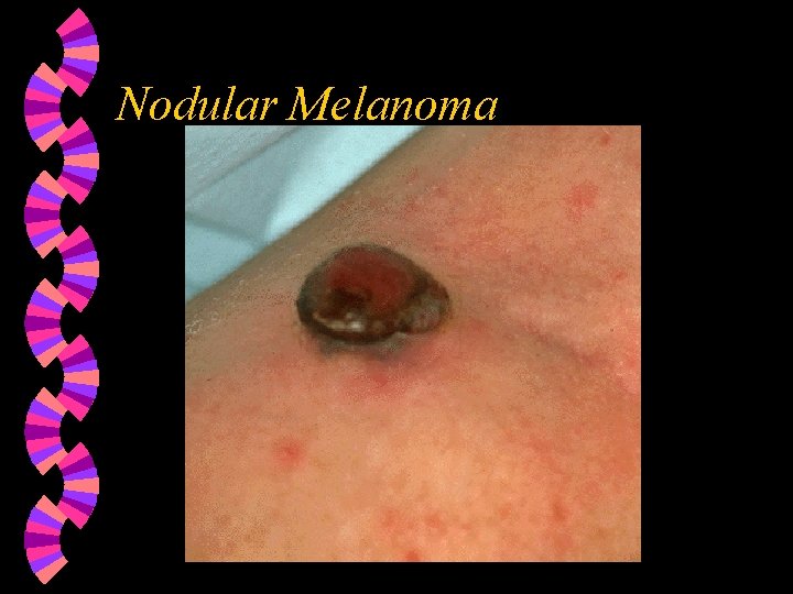 Nodular Melanoma 