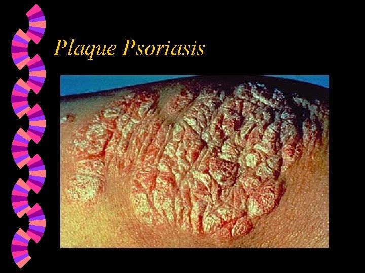 Plaque Psoriasis 