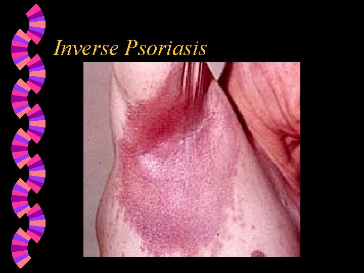 Inverse Psoriasis 