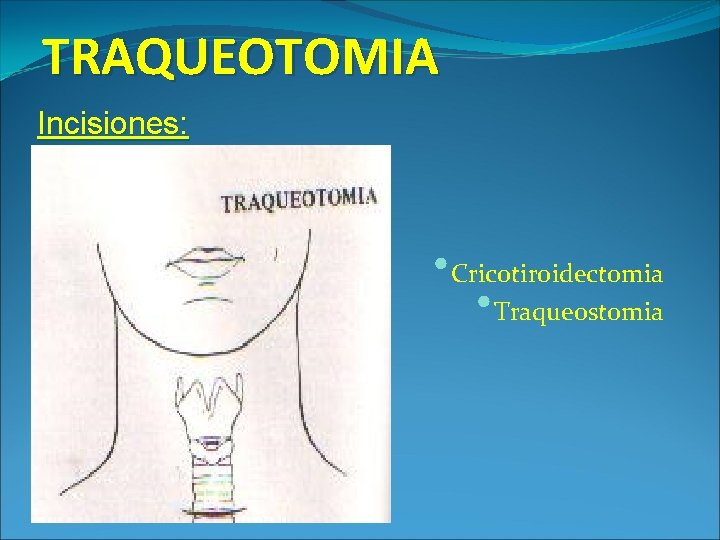 TRAQUEOTOMIA Incisiones: • Cricotiroidectomia • Traqueostomia 