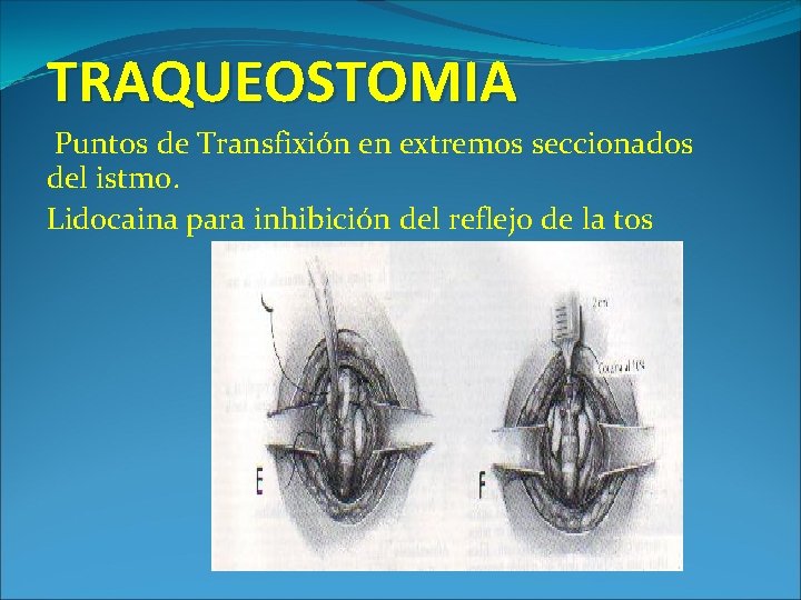 TRAQUEOSTOMIA Puntos de Transfixión en extremos seccionados del istmo. Lidocaina para inhibición del reflejo