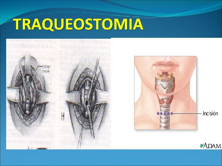 TRAQUEOSTOMIA 