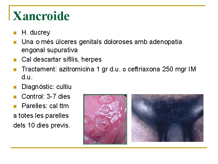 Xancroide H. ducrey n Una o més úlceres genitals doloroses amb adenopatia engonal supurativa