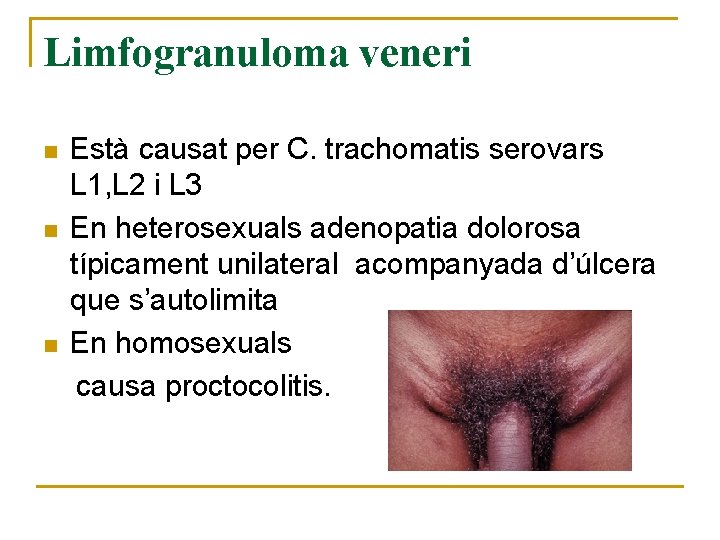 Limfogranuloma veneri n n n Està causat per C. trachomatis serovars L 1, L