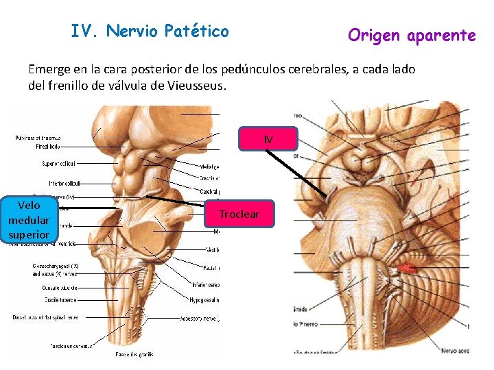 IV. Nervio Patético Origen aparente Emerge en la cara posterior de los pedúnculos cerebrales,