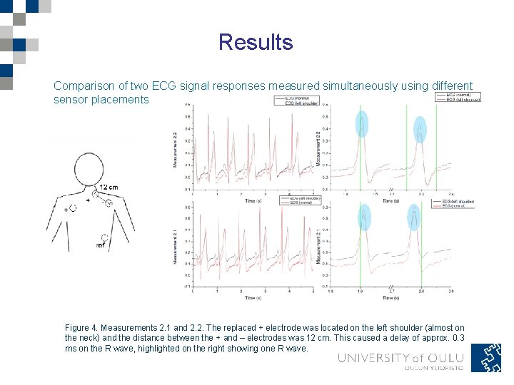 Results Comparison of two ECG signal responses measured simultaneously using different sensor placements Figure Results Comparison of two ECG signal responses measured simultaneously using different sensor placements Figure