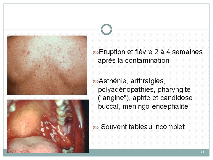  Eruption et fièvre 2 à 4 semaines après la contamination Asthénie, arthralgies, polyadénopathies,