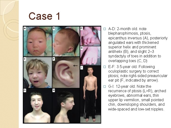 Case 1 � A-D: 2 -month old. note blepharophimosis, ptosis, epicanthus inversus (A), posteriorly