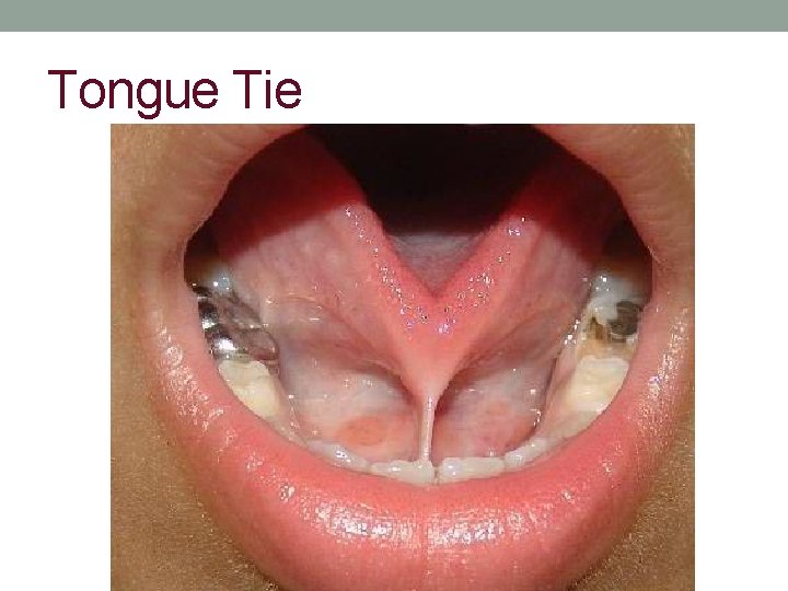 Tongue Tie 