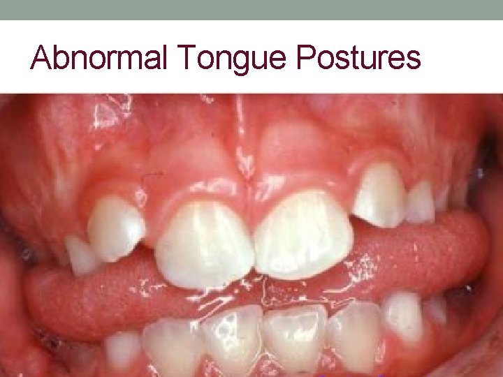 Abnormal Tongue Postures 