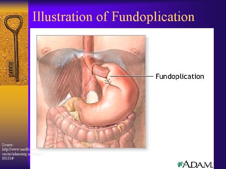 Illustration of Fundoplication Source: http: //www. medformation. c om/ac/adamsurg. nsf/page/1 00181# 