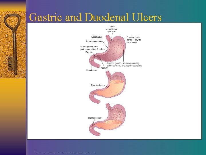 Gastric and Duodenal Ulcers 