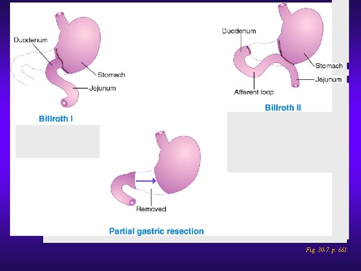 Gastric surgical procedures. Fig. 30 -7. p. 661. 