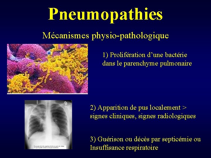 Pneumopathies Mécanismes physio-pathologique 1) Prolifération d’une bactérie dans le parenchyme pulmonaire 2) Apparition de