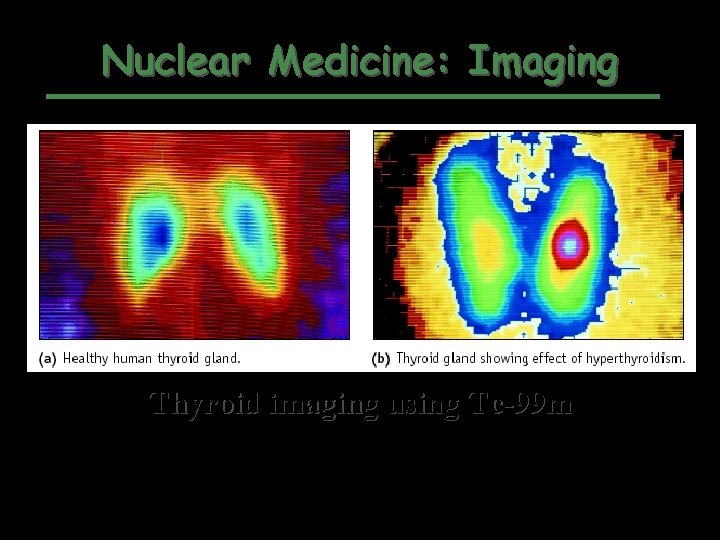 Nuclear Medicine: Imaging Thyroid imaging using Tc-99 m 