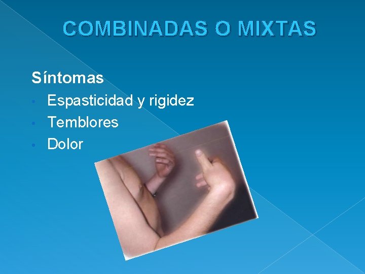 COMBINADAS O MIXTAS Síntomas Espasticidad y rigidez • Temblores • Dolor • 
