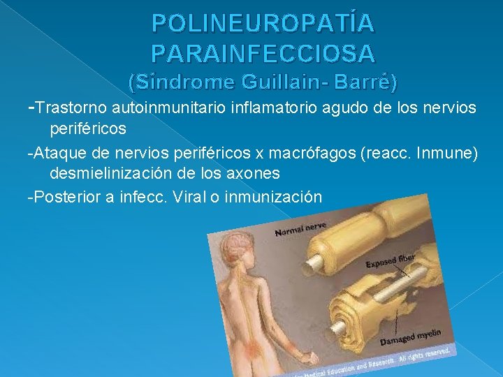 POLINEUROPATÍA PARAINFECCIOSA (Síndrome Guillain- Barré) -Trastorno autoinmunitario inflamatorio agudo de los nervios periféricos -Ataque