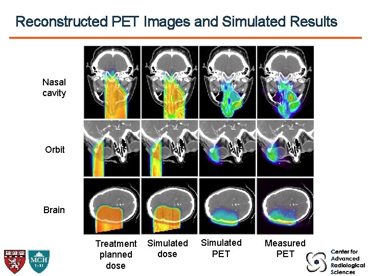 Reconstructed PET Images and Simulated Results Nasal cavity Orbit Brain Treatment planned dose Simulated