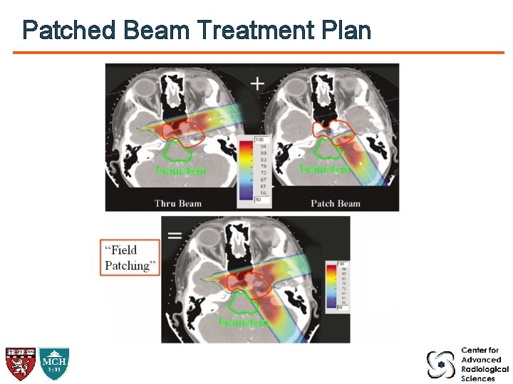 Patched Beam Treatment Plan 