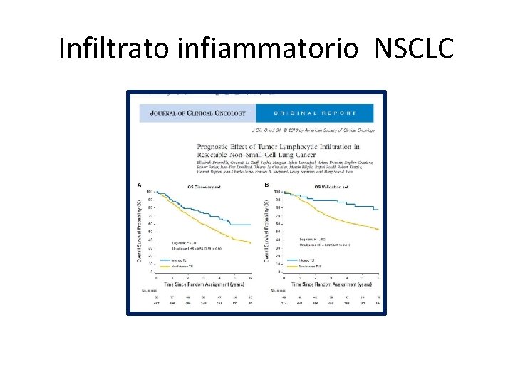 Infiltrato infiammatorio NSCLC 