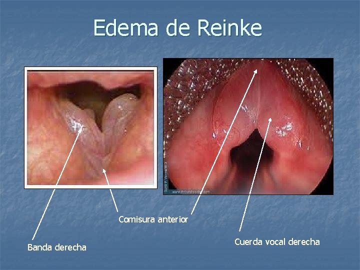 Edema de Reinke Comisura anterior Banda derecha Cuerda vocal derecha 