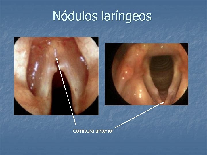 Nódulos laríngeos Comisura anterior 