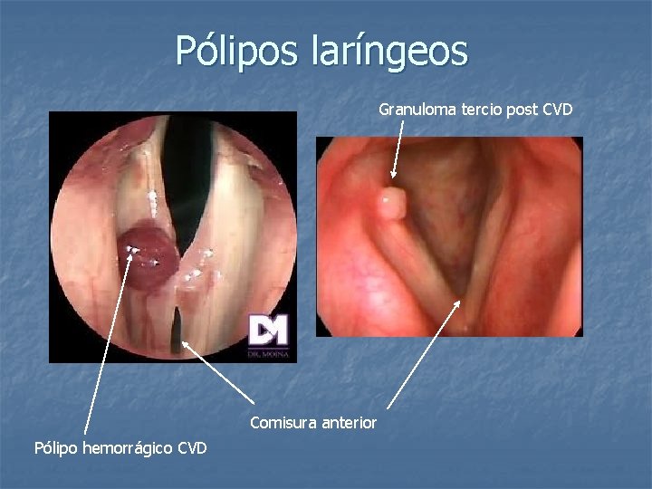 Pólipos laríngeos Granuloma tercio post CVD Comisura anterior Pólipo hemorrágico CVD 
