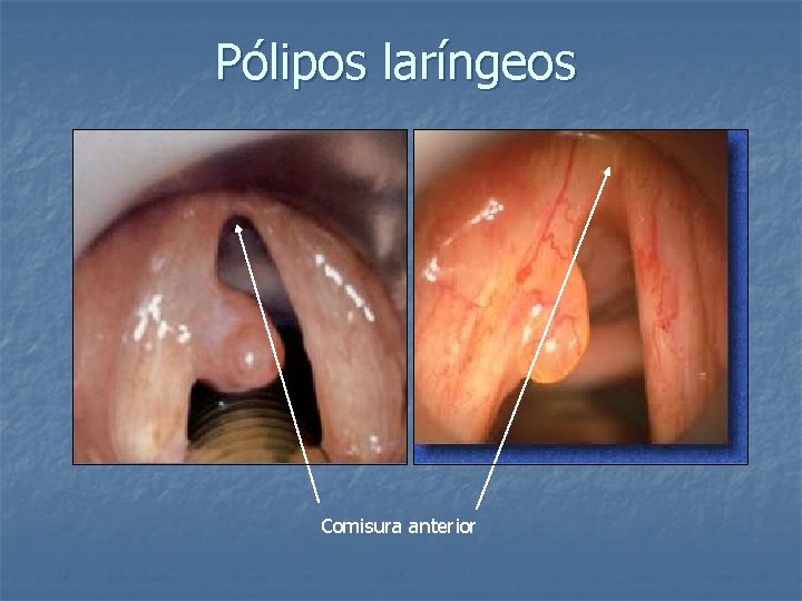 Pólipos laríngeos Comisura anterior 
