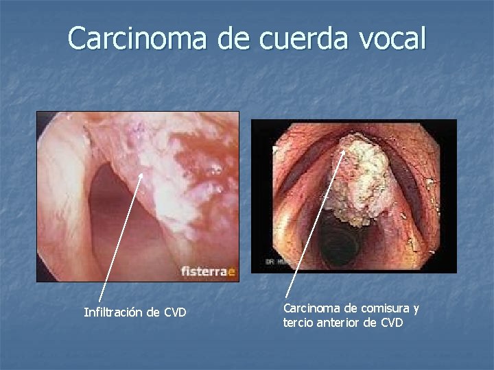 Carcinoma de cuerda vocal Infiltración de CVD Carcinoma de comisura y tercio anterior de