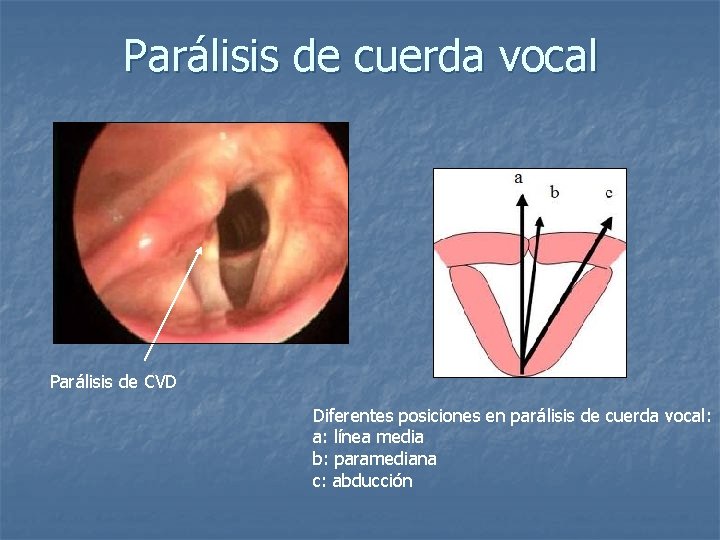 Parálisis de cuerda vocal Parálisis de CVD Diferentes posiciones en parálisis de cuerda vocal: