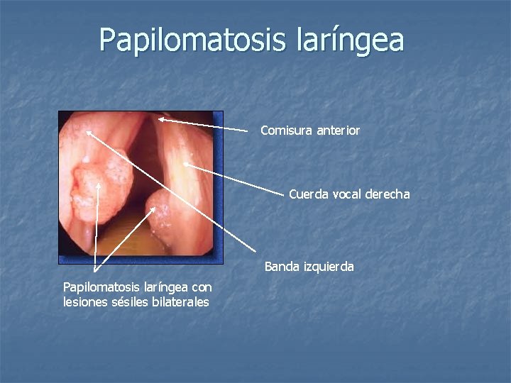 Papilomatosis laríngea Comisura anterior Cuerda vocal derecha Banda izquierda Papilomatosis laríngea con lesiones sésiles