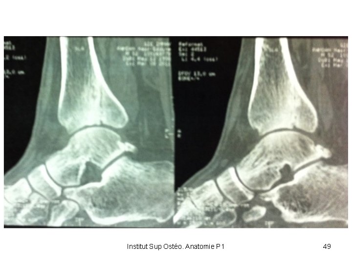 Institut Sup Ostéo. Anatomie P 1 49 