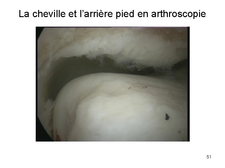 La cheville et l’arrière pied en arthroscopie 51 