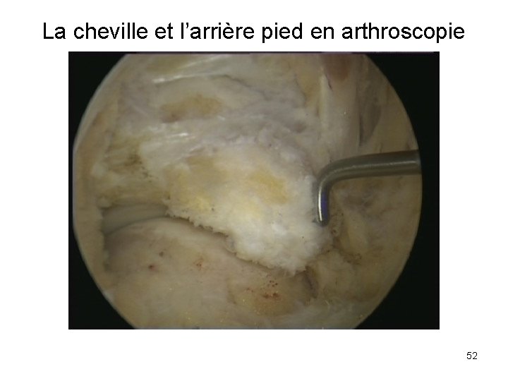 La cheville et l’arrière pied en arthroscopie 52 