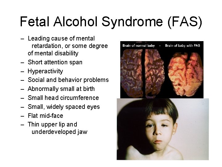 Fetal Alcohol Syndrome (FAS) – Leading cause of mental retardation, or some degree of
