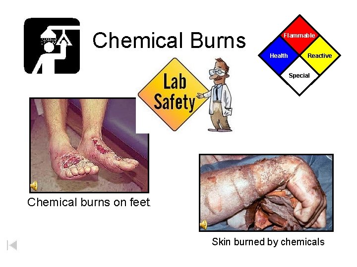 Chemical Burns Flammable Health Reactive Special Chemical burns on feet. Skin burned by chemicals