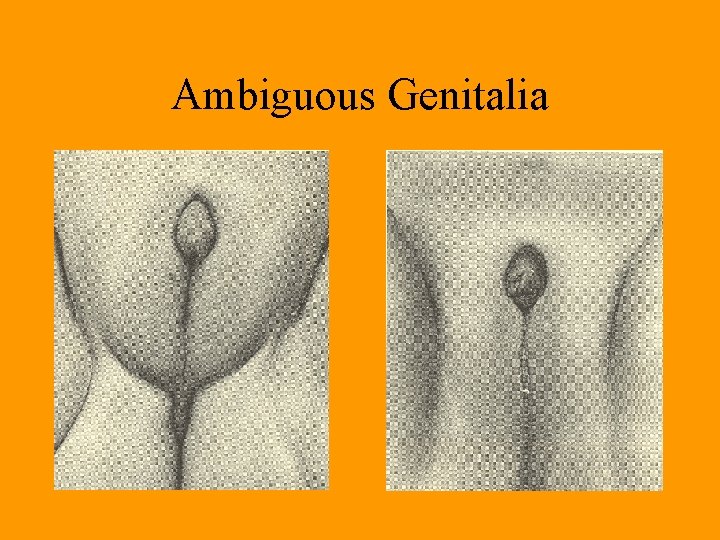 Ambiguous Genitalia Ambiguous Genitalia