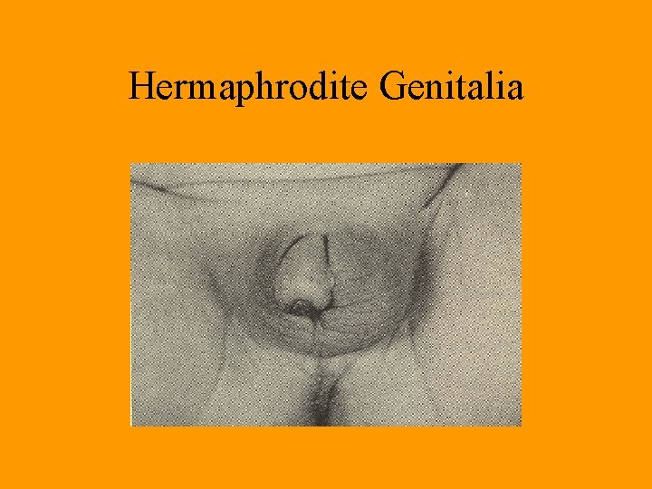 Hermaphrodite Genitalia Hermaphrodite Genitalia