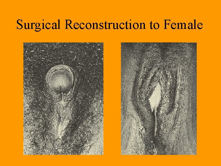Surgical Reconstruction to Female Surgical Reconstruction to Female