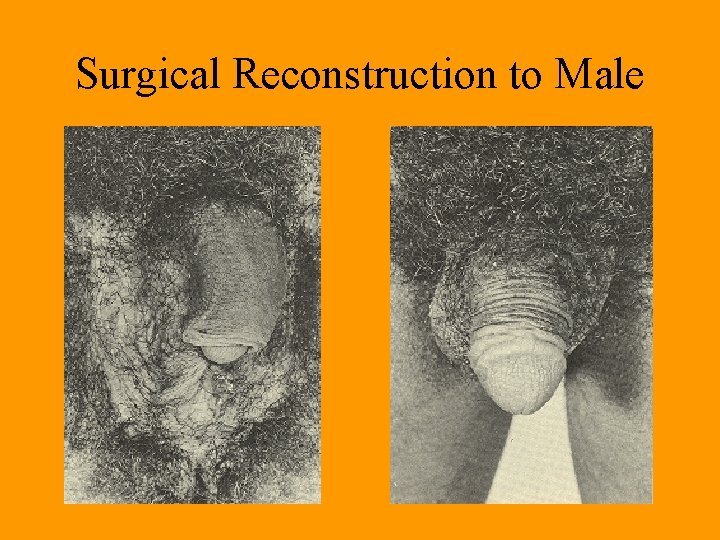 Surgical Reconstruction to Male Surgical Reconstruction to Male