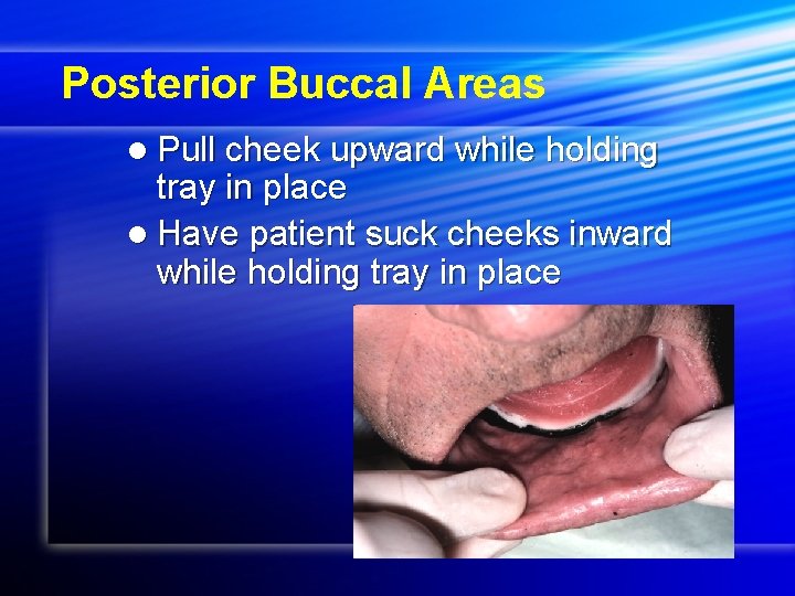 Posterior Buccal Areas l Pull cheek upward while holding tray in place l Have