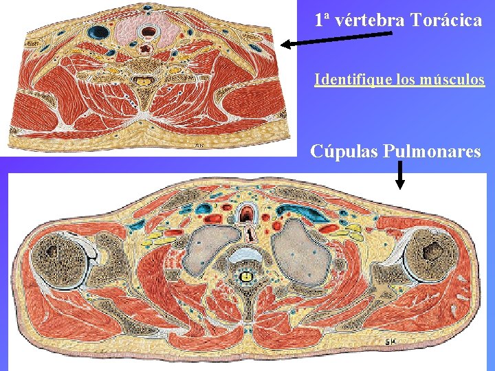 1ª vértebra Torácica Identifique los músculos Cúpulas Pulmonares 