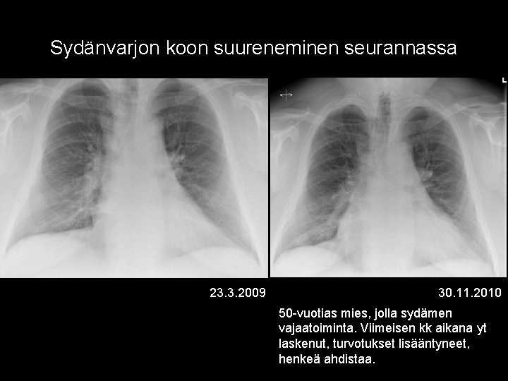 Sydänvarjon koon suureneminen seurannassa 23. 3. 2009 30. 11. 2010 50 -vuotias mies, jolla