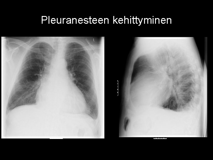 Pleuranesteen kehittyminen 